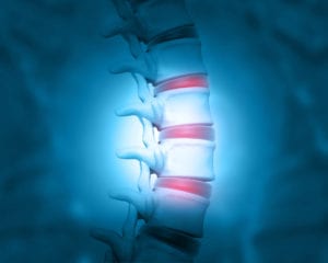 Disc problem of human spine. 3d illustration - Bulging Disc