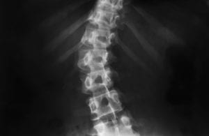 X-ray of scoliosis, selective focus.