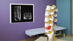 Model of a spinal stenosis