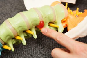 Doctor pointing out a disc herniation