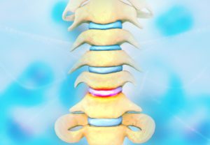 Disc problem of human spine. 3d illustration