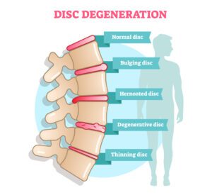 disc degenerative disease