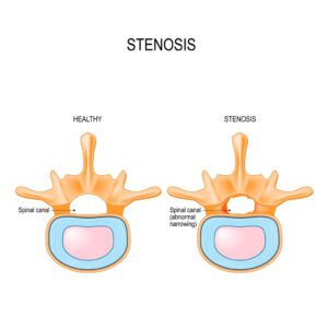 Spinal Stenosis is an abnormal narrowing in spinal canal