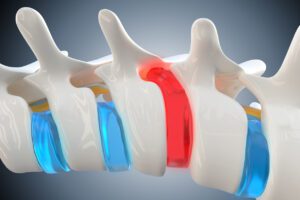 Herniated disc compresses the spinal cord