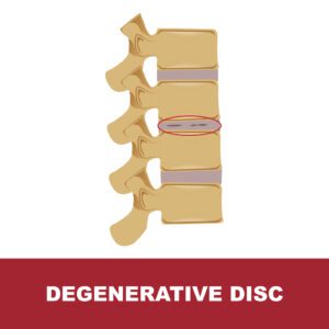 human disc degeneration. degenerative disc vector illustration