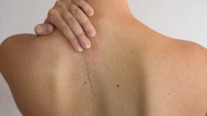 Caucasian woman's upper back with a scar from back surgery