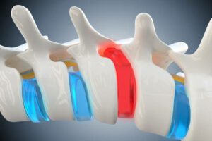 Herniated, prolapsed disk compresses the spinal cord causing back pain and other health problems, 3d illustration