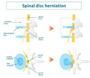 Illustration of lumbar disc herniation