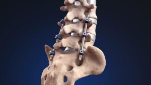Image of a posterior lumbar fusion of the spine, featuring pedicle screws and rods.
