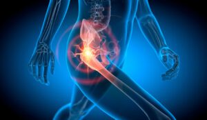 3D X-ray illustration of a running man experiencing pain in the hip joint and sacroiliac (SI) joint.