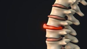 3D image illustration of a bulging disc in the human spine as a sign of spinal stenosis condition.