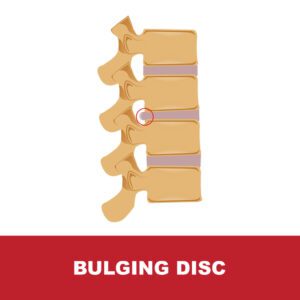 Bulging disc illustration