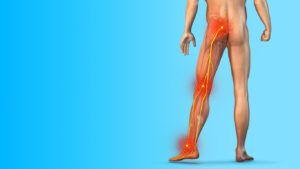 Three Sciatica Pain Points Highlighted on Blue.
